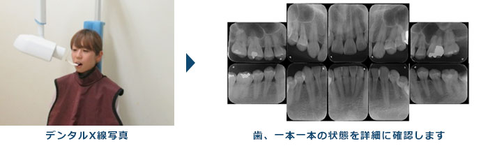 デンタルX線写真