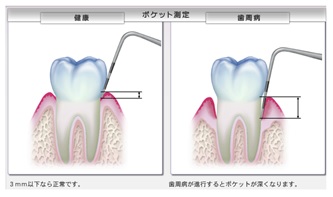 ポケット測定