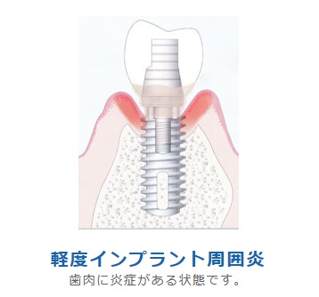 軽度インプラント周囲炎