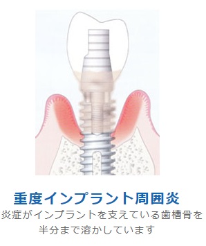 重度インプラント周囲炎