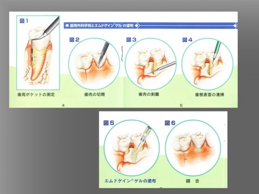 ④再生療法　エムドゲイン