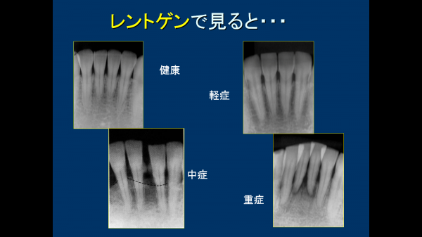 ②歯周病の段階　デンタル