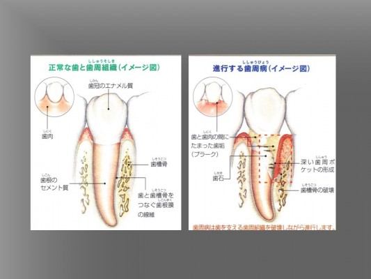 ③歯周病の進行